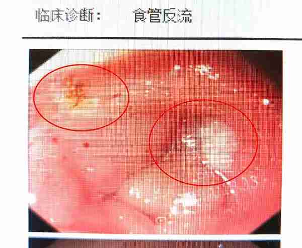 25岁发现胃溃疡，只因错把腹痛当胃炎