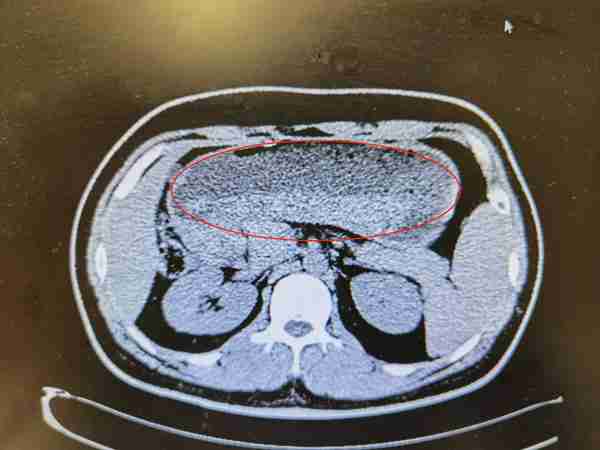 胃溃疡图片(胃镜胃溃疡图片)